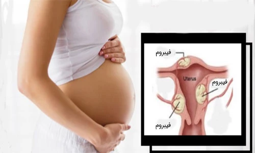 سابقه عمل میومکتومی