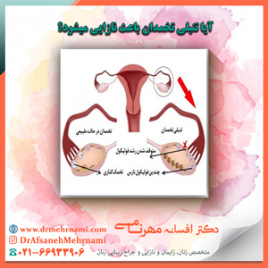 آیا تنبلی تخمدان باعث نازایی میشود؟