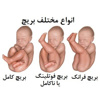 انواع مختلف بریچ