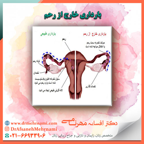 بارداری خارج از رحم