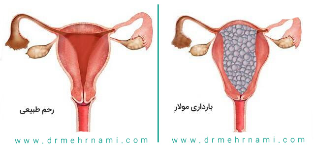 بارداری-پوچ