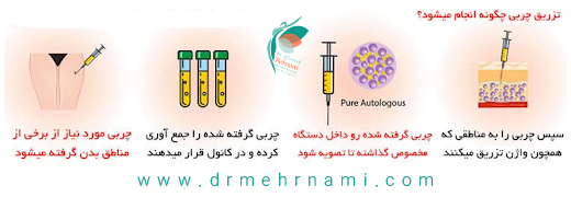 تزریق-چربی-چگونه-انجام-می-شود؟