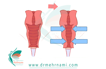 تنگ-کردن-واژن
