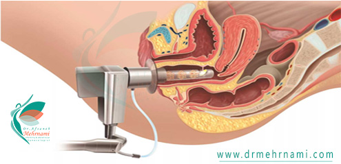 تنگ-کردن-واژن-با-لیزر