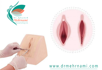 تنگ-کردن-واژن-با-نخ