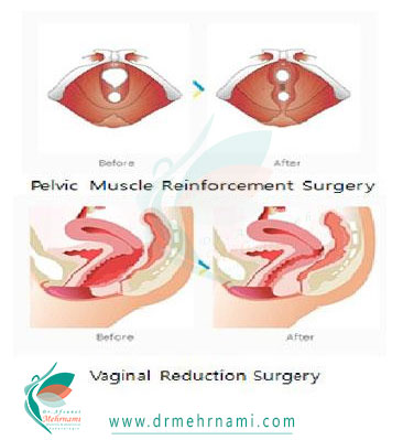 جراحی-تنگ-کردن-واژن