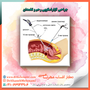 جراحی لاپاراسکوپی رحم و تخمدان