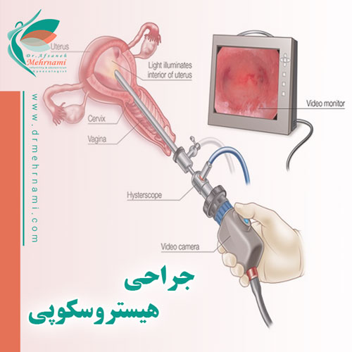 جراحی-هیستروسکوپی