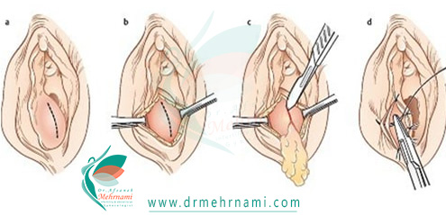 جراحی-پرینورافی