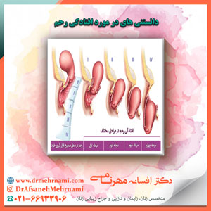 دانستنی های در مورد افتادگی رحم
