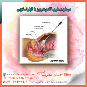 درمان بیماری آندومتریوز با لاپاراسکوپی