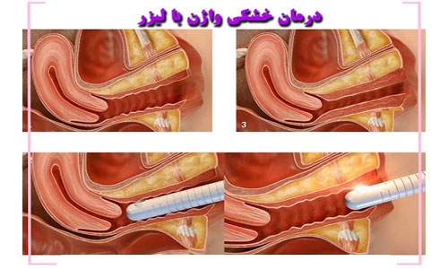 درمان خشکی واژن با لیزر
