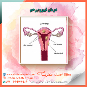 درمان فیبروم رحم