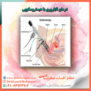 درمان ناباروری با هیستروسکوپی