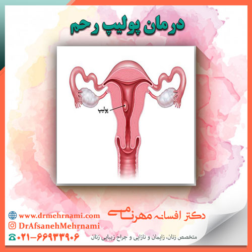 درمان پولیپ رحم