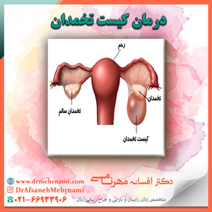 درمان کیست تخمدان