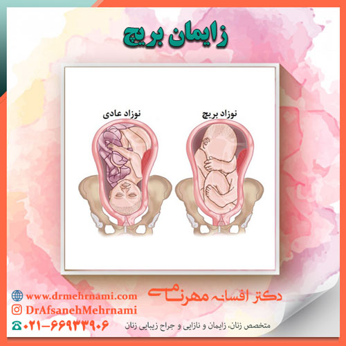 زایمان بریچ