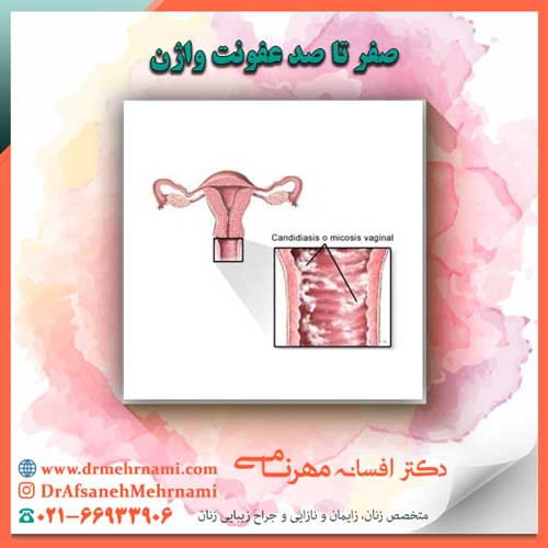 صفر تا صد عفونت واژن