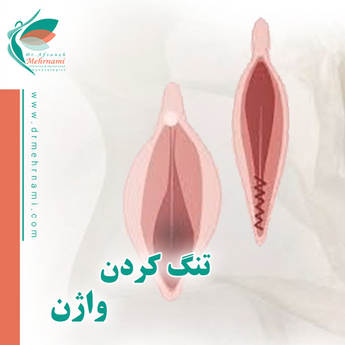 عمل-تنگ-کردن-واژن