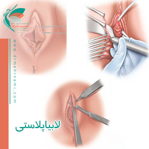 لابیاپلاستی