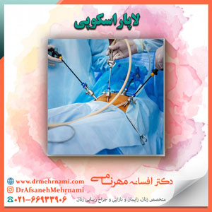 لاپاراسکوپی