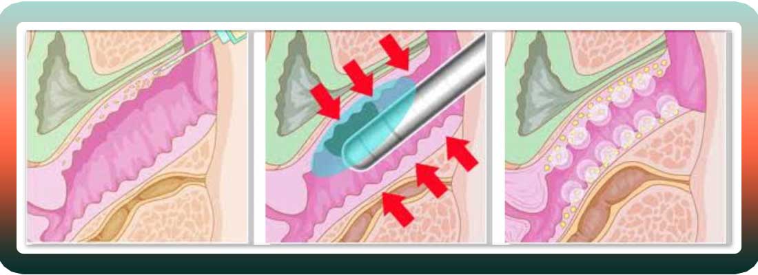 لیزر جوانسازی واژن