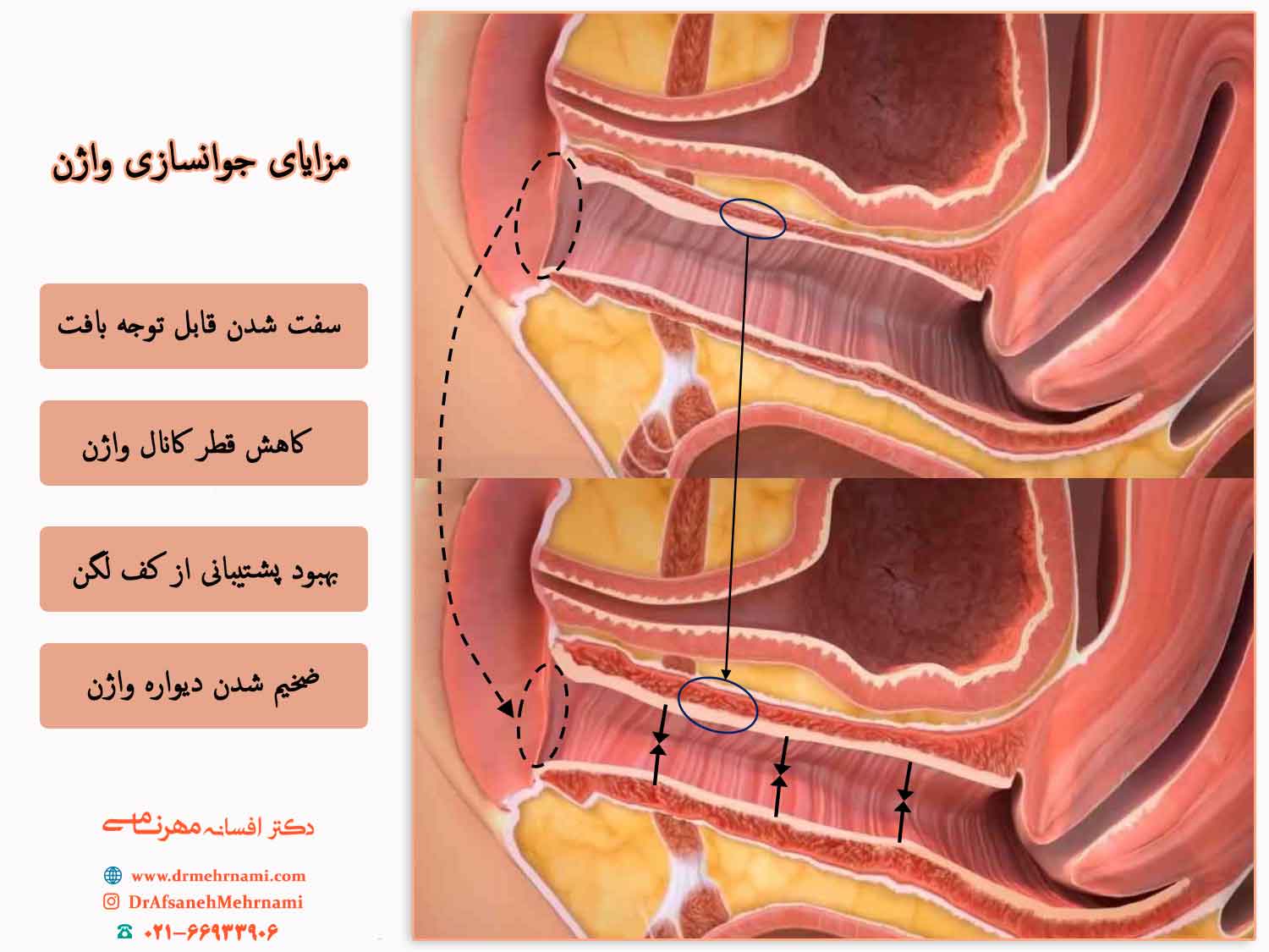 مزایای-جوانسازی-واژن دکتر افسانه مهرنامی متخصص زنان و زایمان در تهران