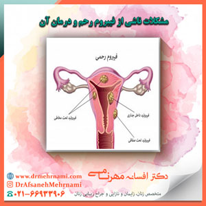 مشکلات ناشی از فیبروم رحم و درمان آن