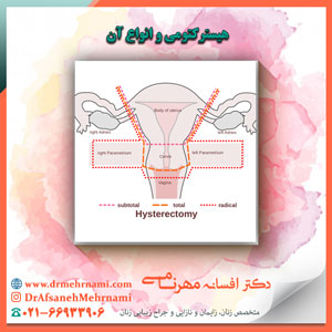 هیسترکتومی و انواع آن