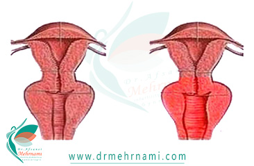 واژینوپلاستی