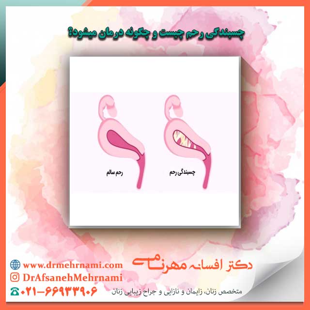 چسبندگی رحم چیست و چگونه درمان میشود؟
